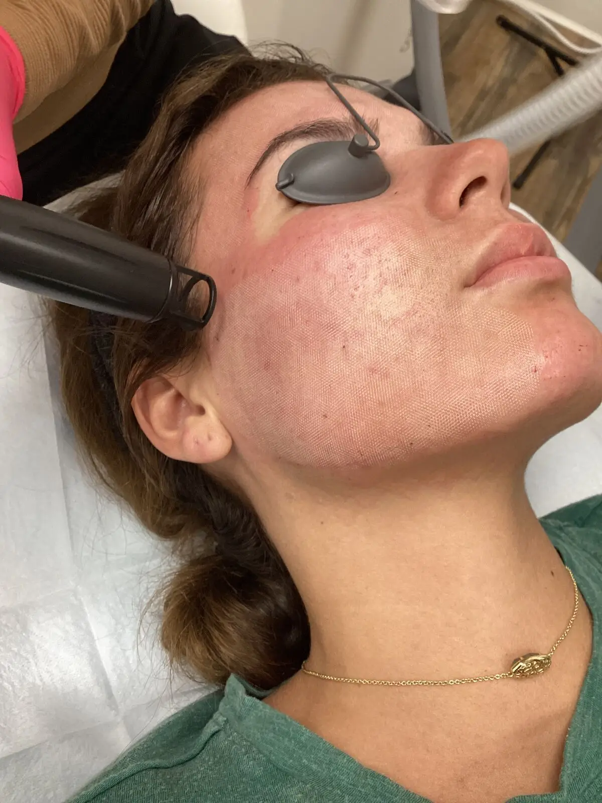 Fractional Erbium YAG laser treatment at Opteluxe Wellness