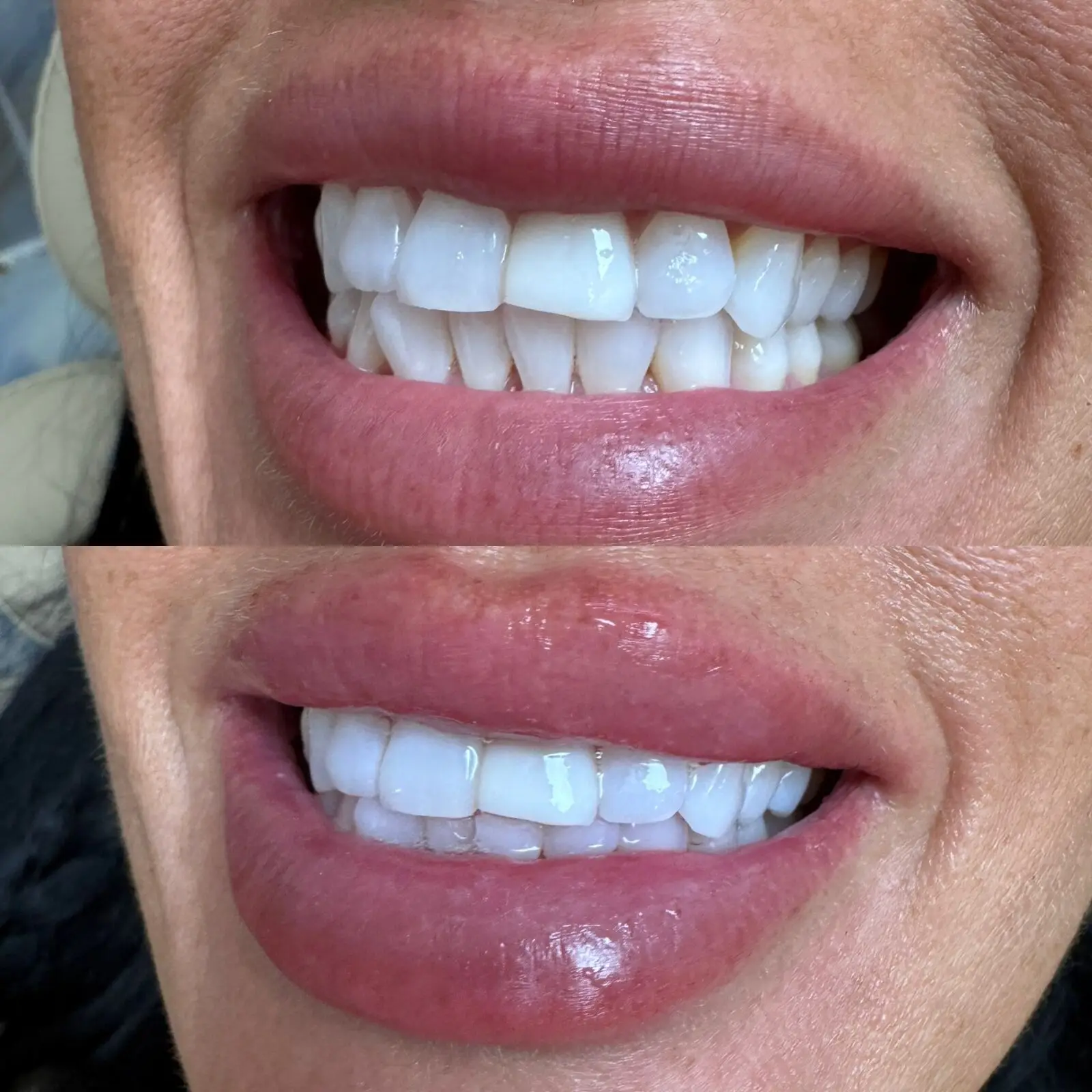 Lip filler before and after at Opteluxe Wellness — front view