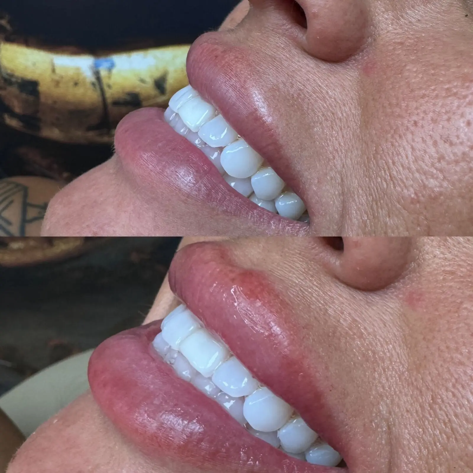 Lip filler before and after at Opteluxe Wellness — side profile