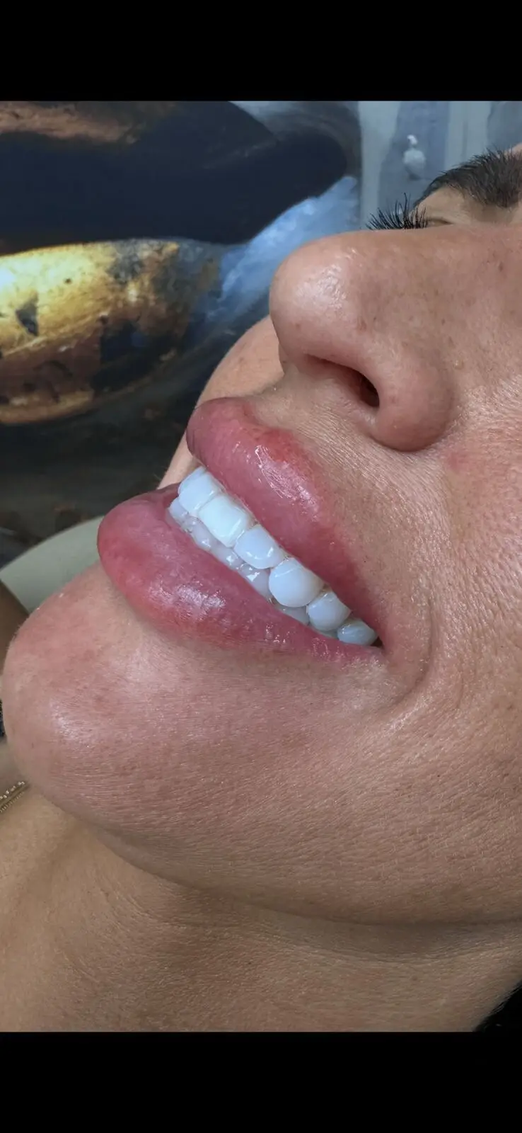 Lip filler results at Opteluxe Wellness — natural fullness