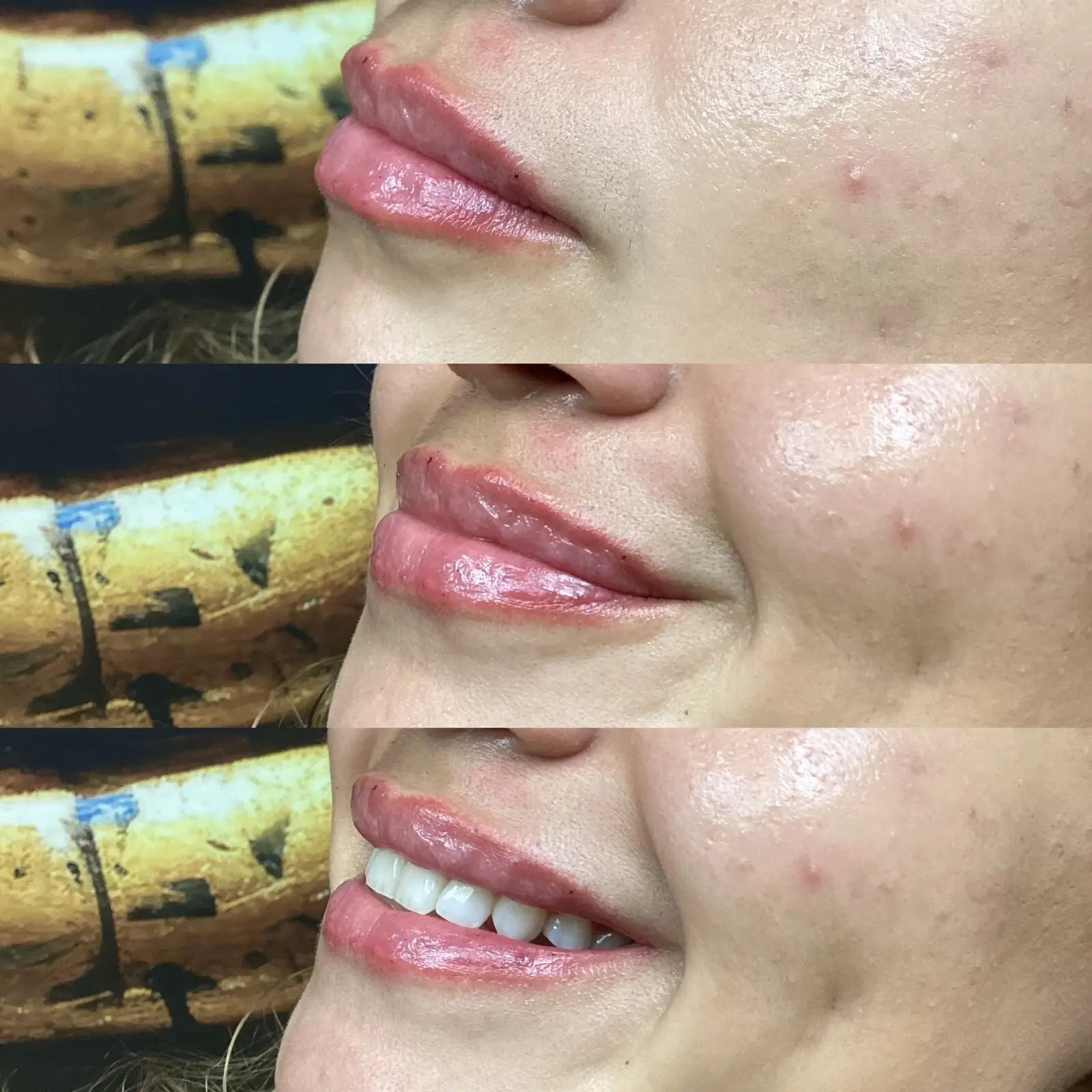 Lip filler progression — three-step before, after, and smile reveal at Opteluxe Wellness