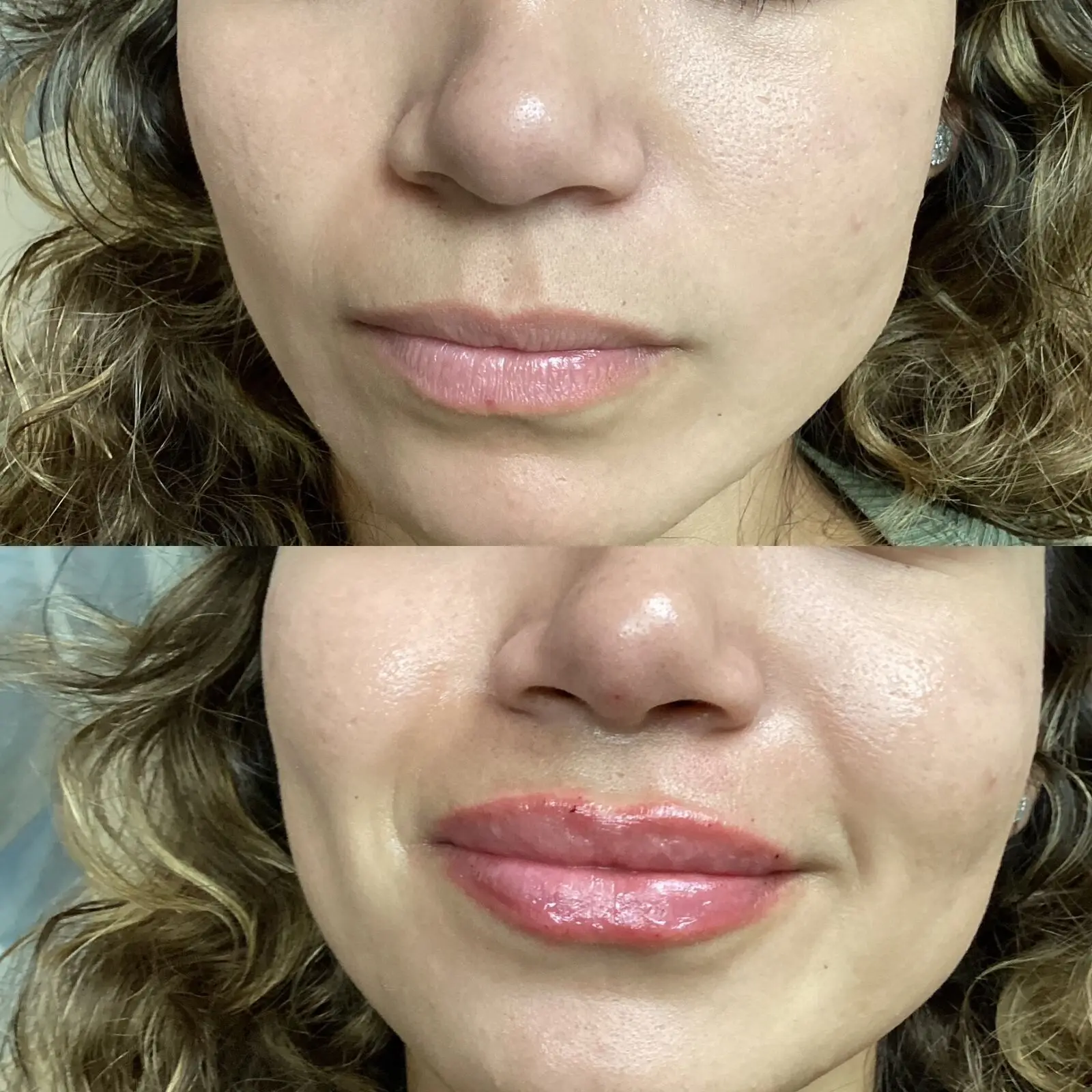Lip filler before and after — front-view fullness and definition at Opteluxe Wellness