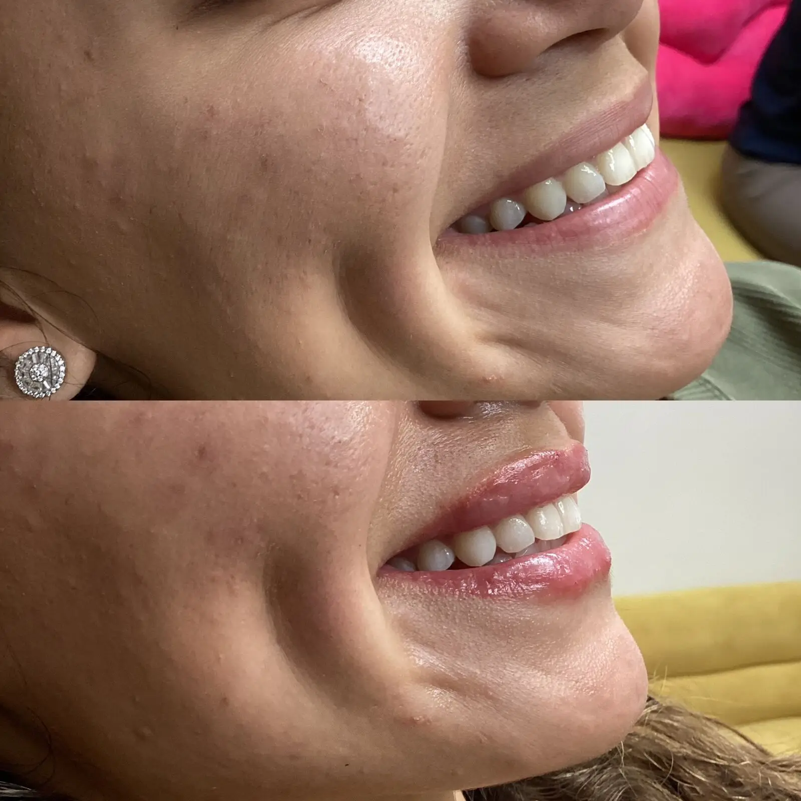 Lip filler before and after — side smile transformation at Opteluxe Wellness