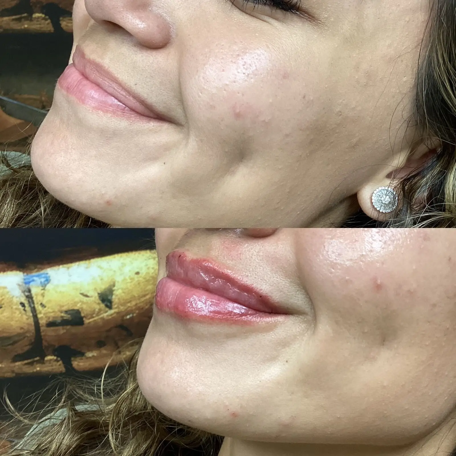 Lip filler before and after — refined shape and hydration at Opteluxe Wellness