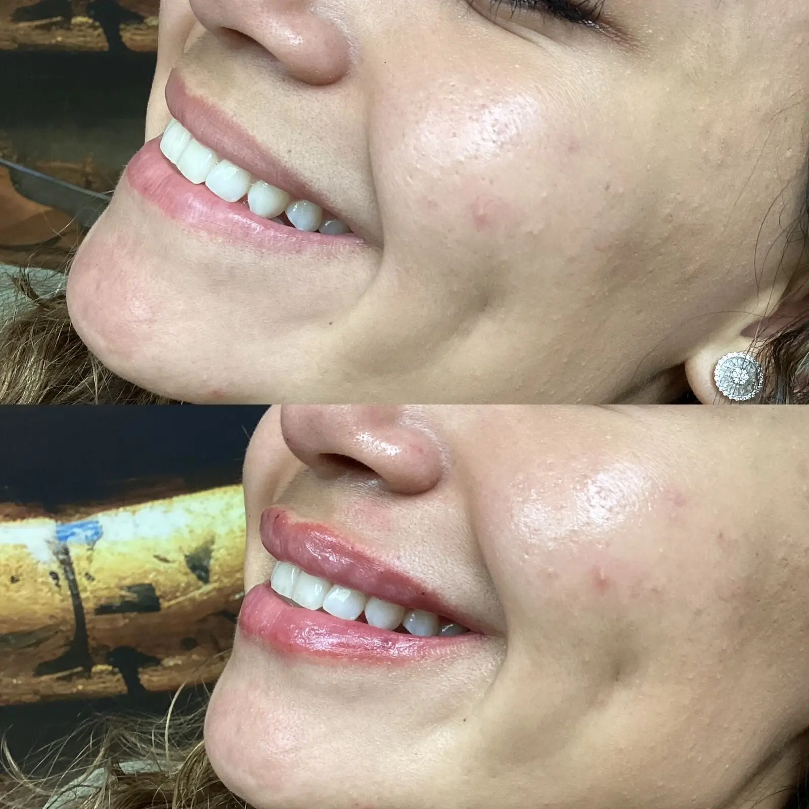 Lip filler before and after — sculpted pout side profile at Opteluxe Wellness