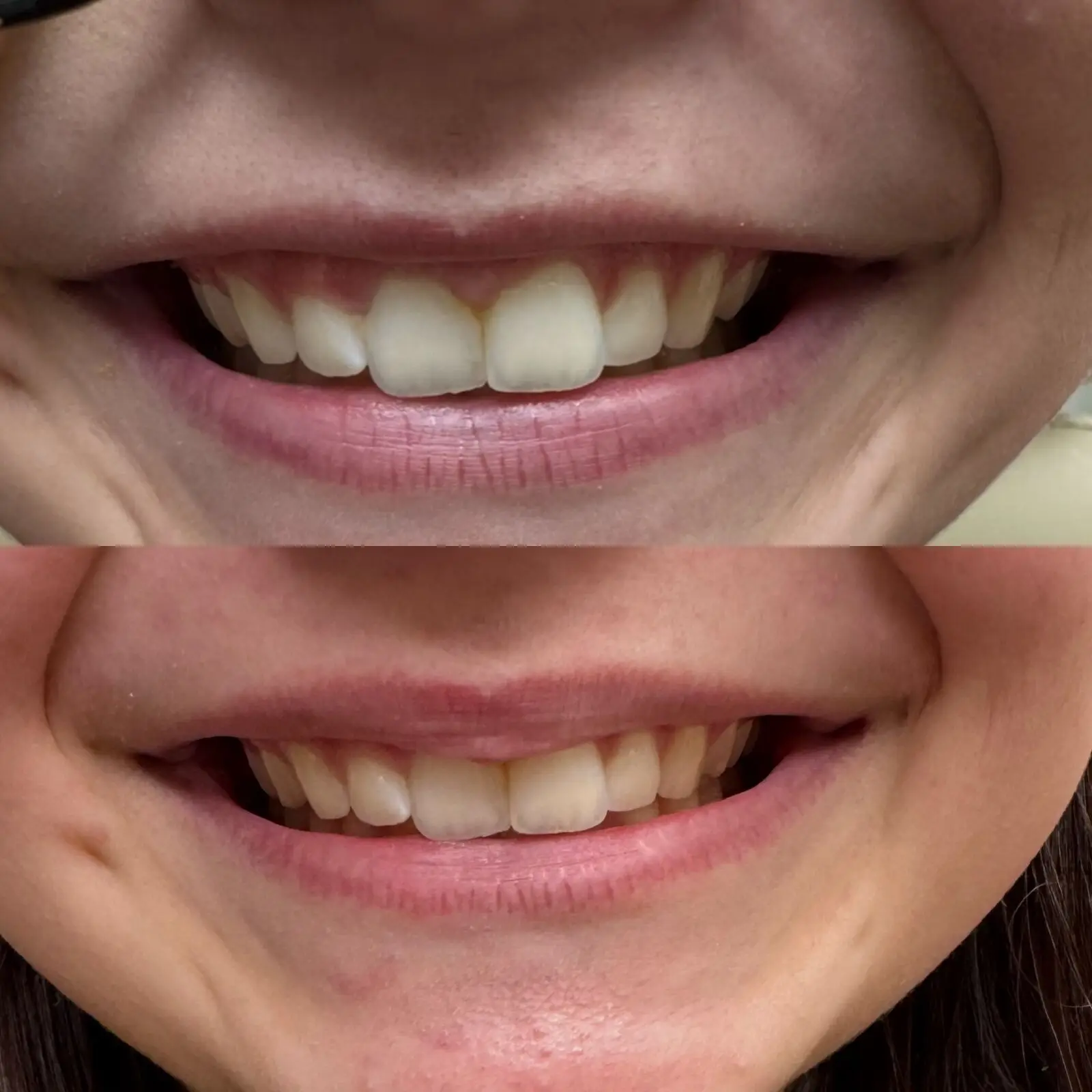Lip flip before and after at Opteluxe Wellness — smile reveal