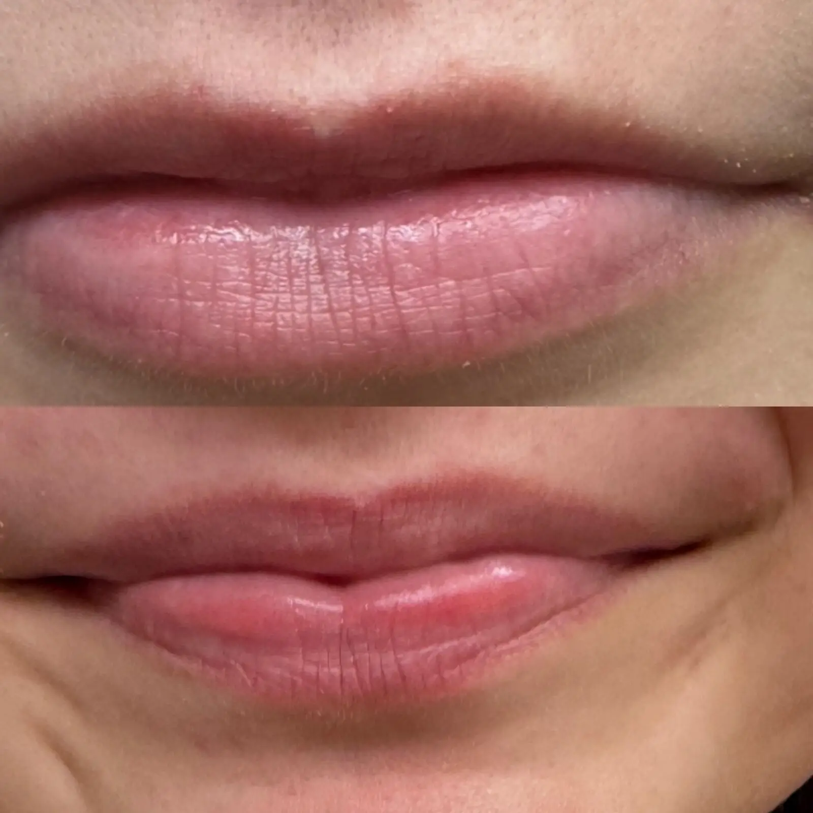 Lip flip before and after at Opteluxe Wellness — relaxed lips