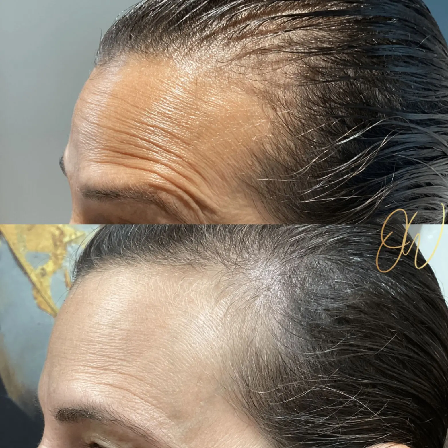 Before and after Xeomin treatment smoothing forehead wrinkles in a male patient