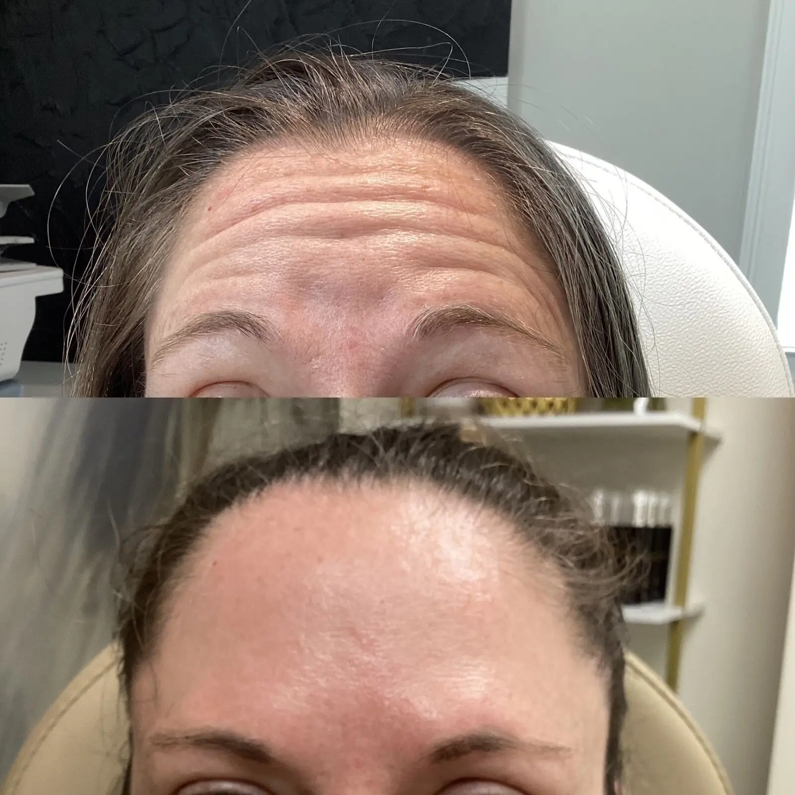 Before and after neurotoxin treatment reducing horizontal forehead lines