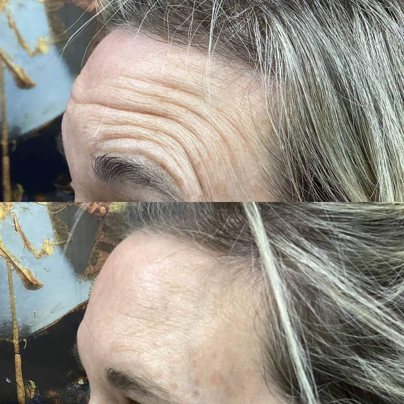 Before and after Xeomin softening deep forehead creases
