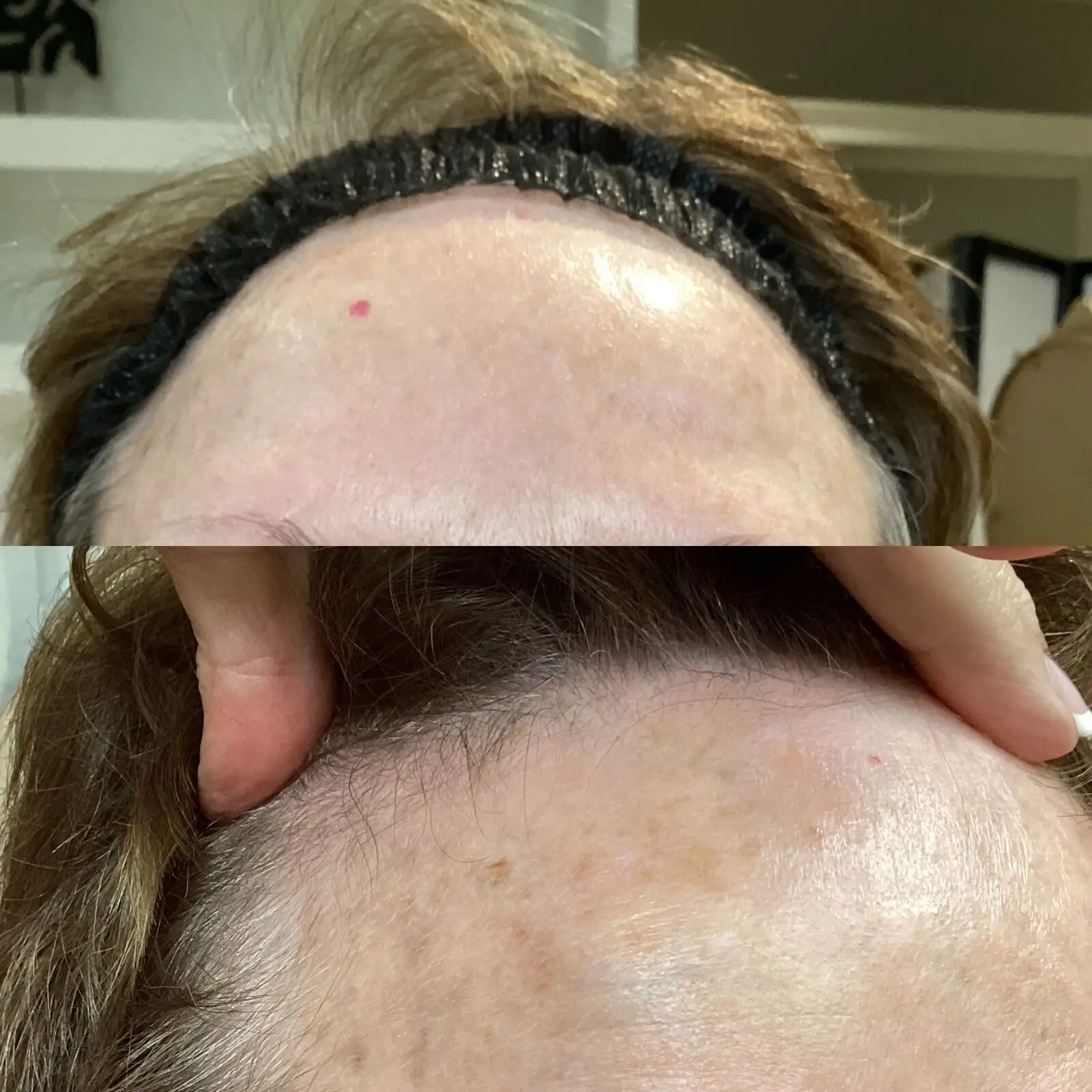 Before and after neurotoxin treatment refining forehead at injection site