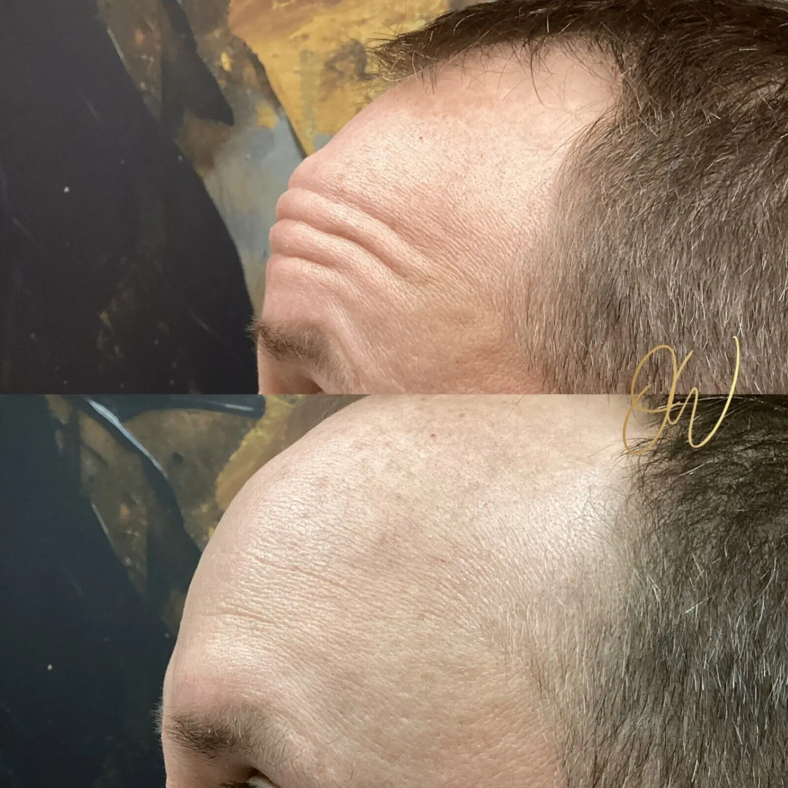 Before and after neurotoxin treatment for forehead lines