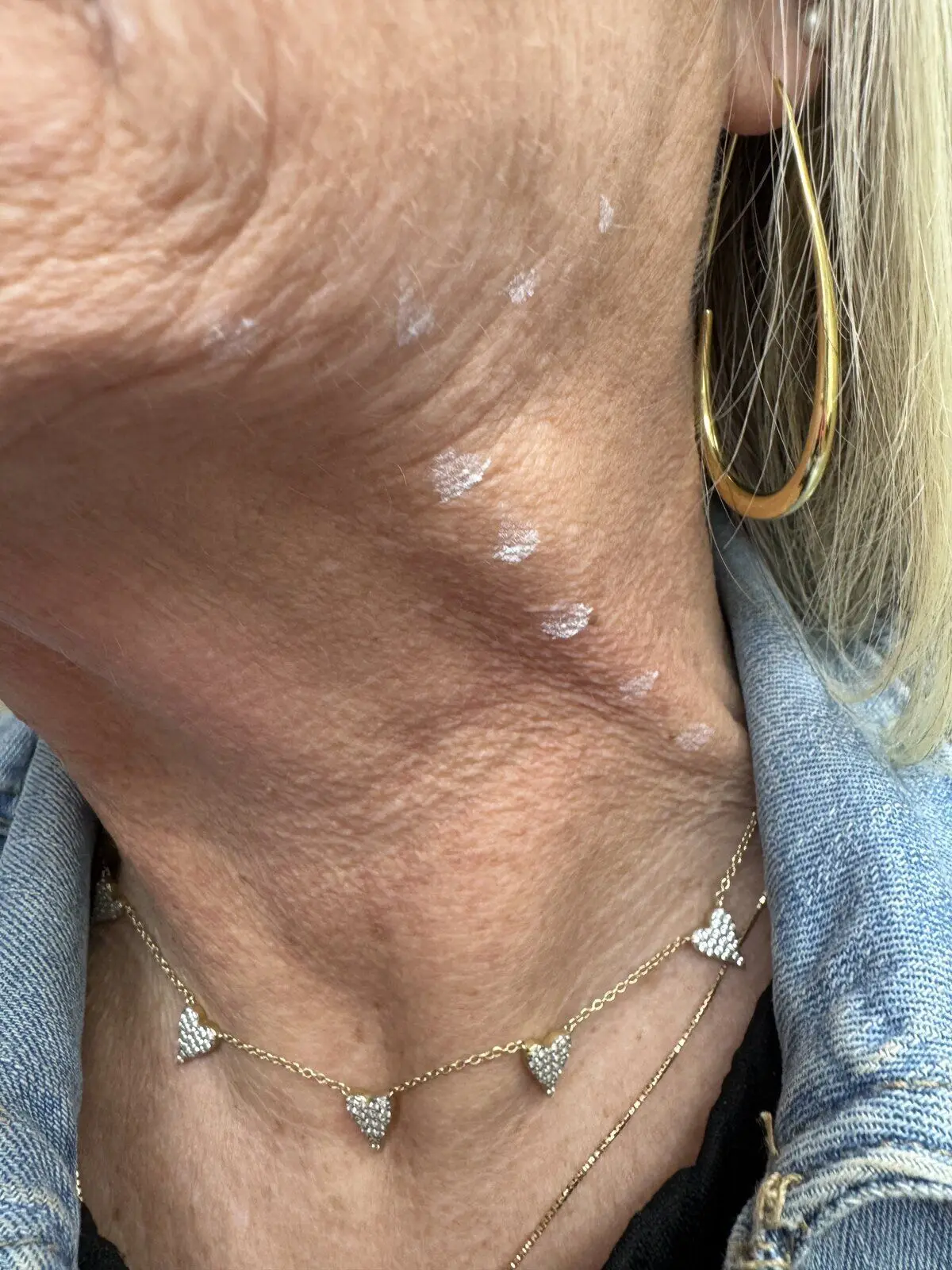 Before and after neurotoxin treatment for platysma neck bands