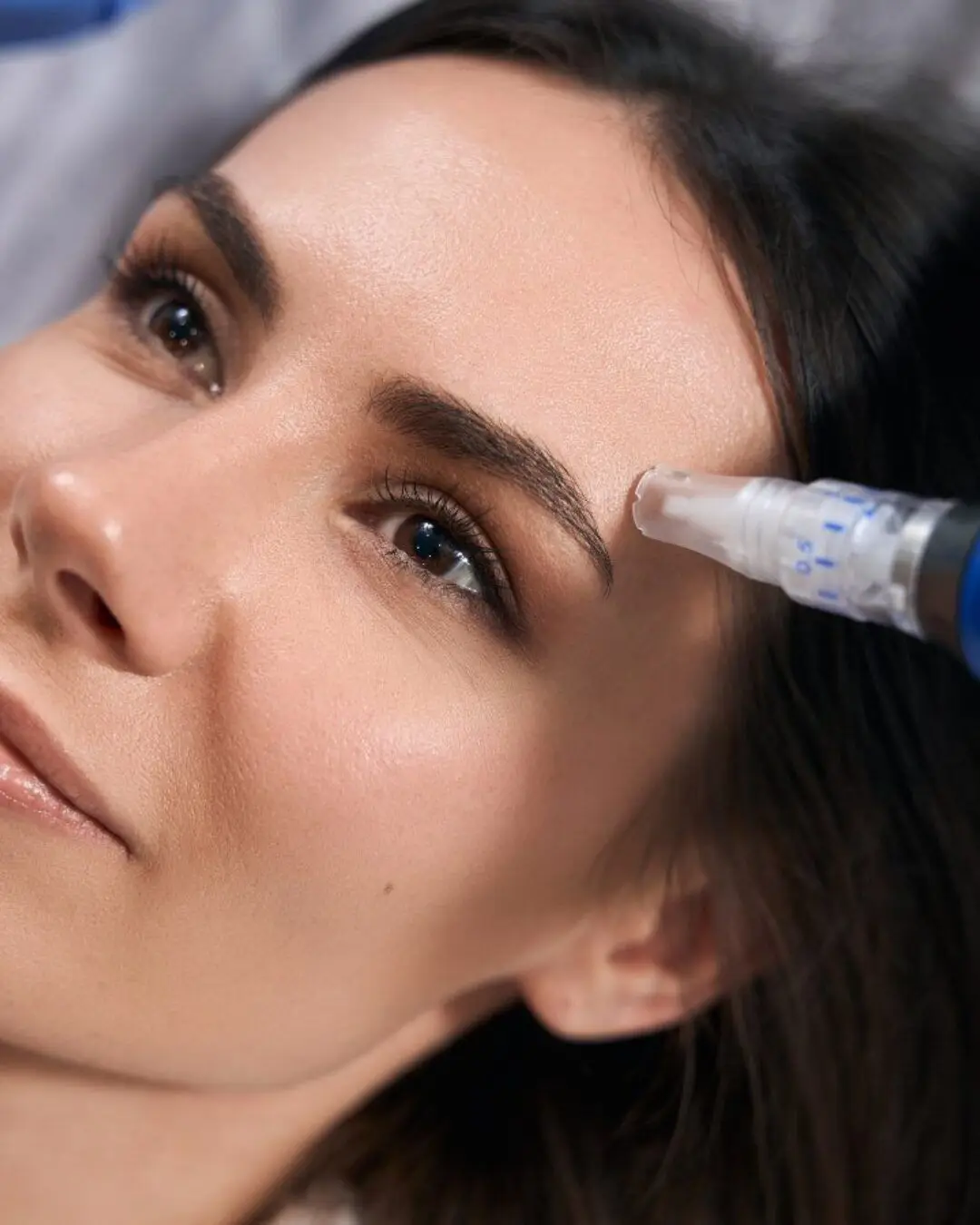 Pixel8 RF Microneedling treatment at Opteluxe Wellness