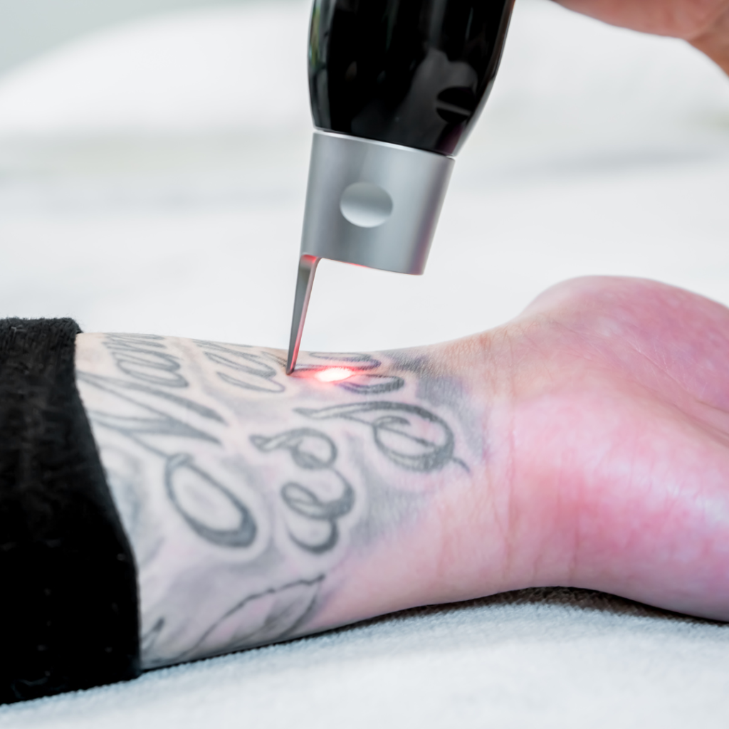 Laser Tattoo Removal