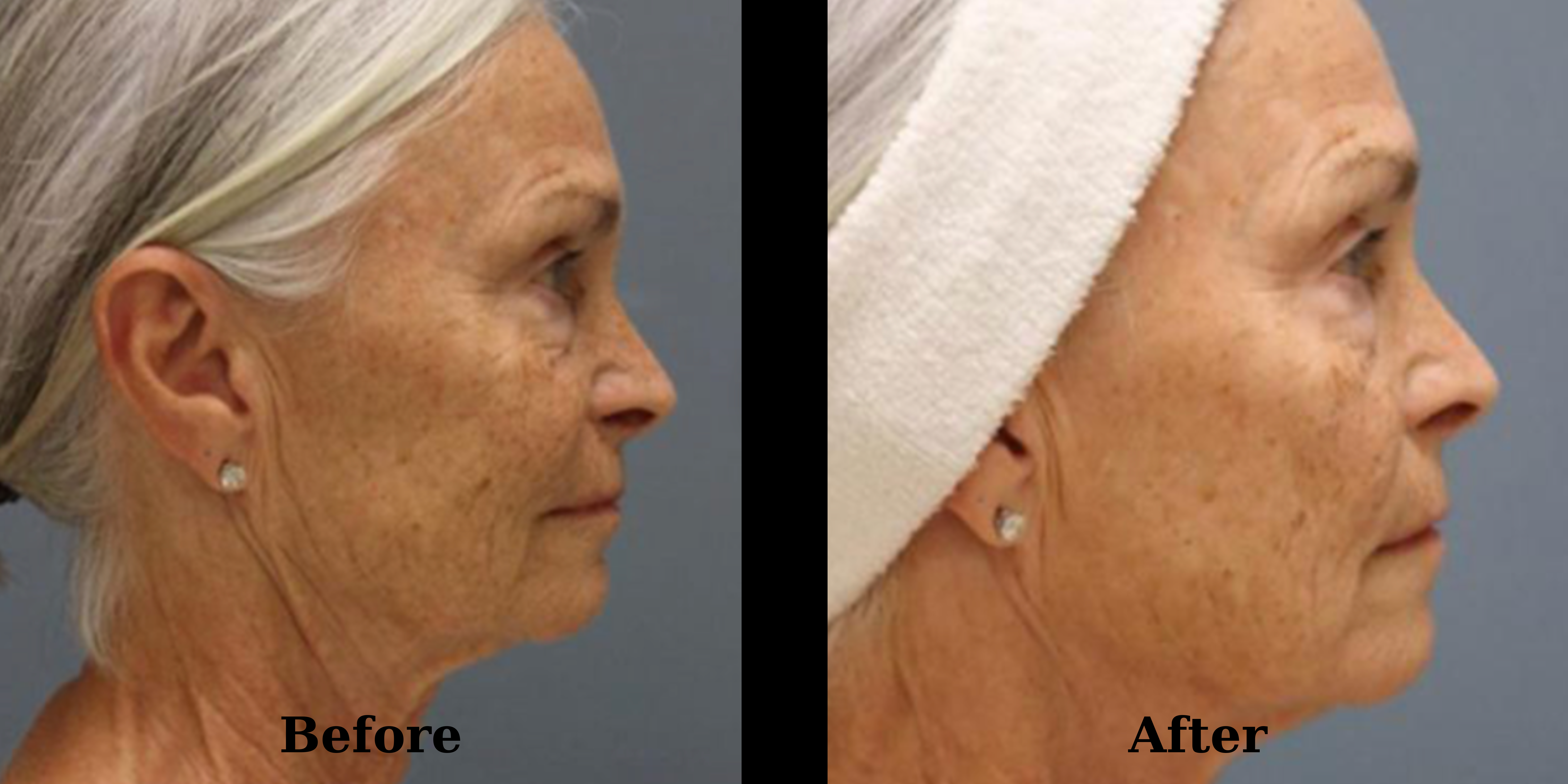 Before & After Pixel8 RF Microneedling