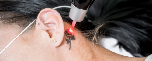 Laser Tattoo Removal