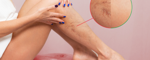 Laser Vein Treatment