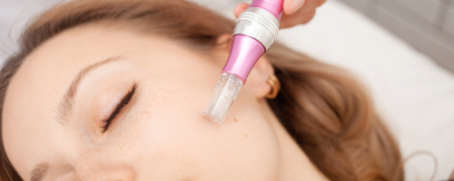 Microneedling With Exosomes