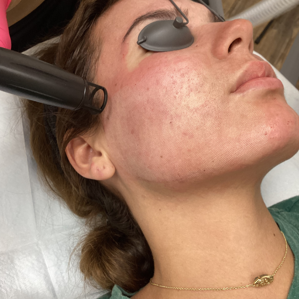 Laser Skin Resurfacing