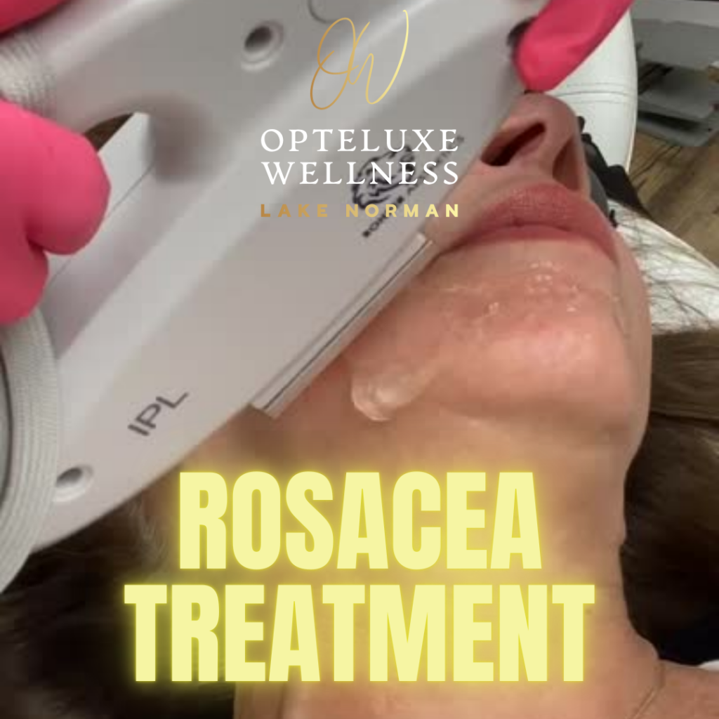 ROSACEA TREATMENT