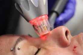 Pixel8 RF Microneedling